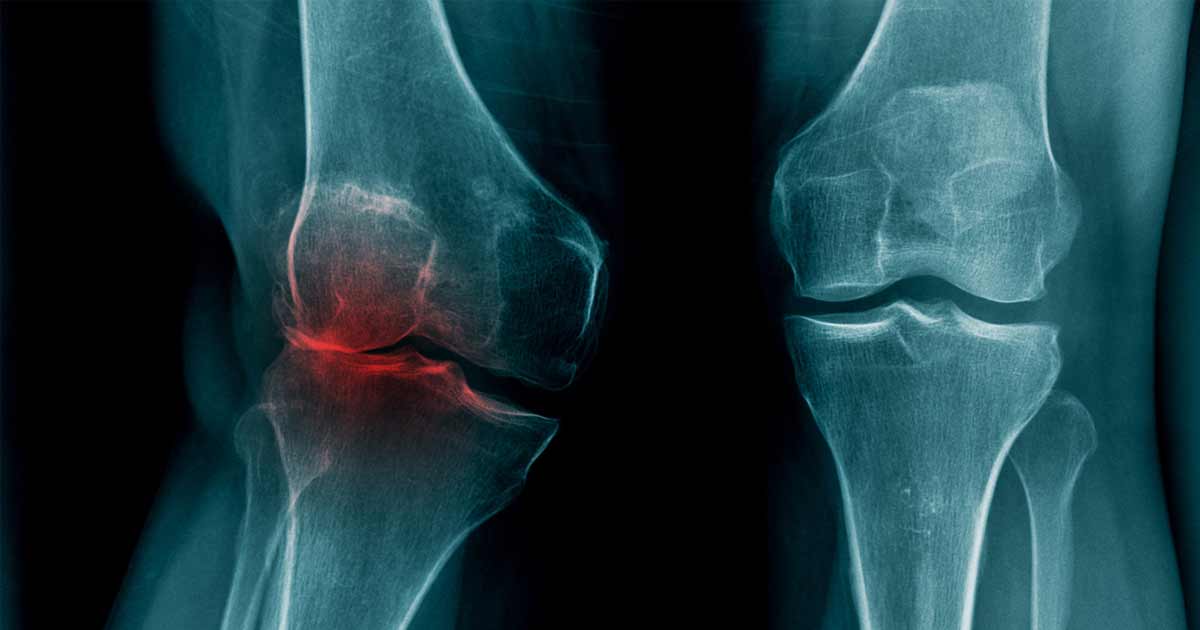 počínající artróza comprimate pentru ameliorarea inflamației în articulația genunchiului